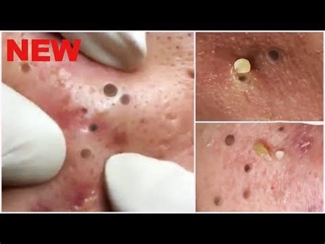 blackheads exploding|large deep nose blackheads removed videos.